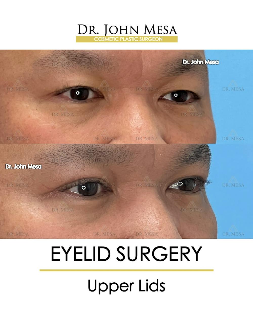 Eyelid Surgery Before & After Gallery - Patient 174902413 - Image 3
