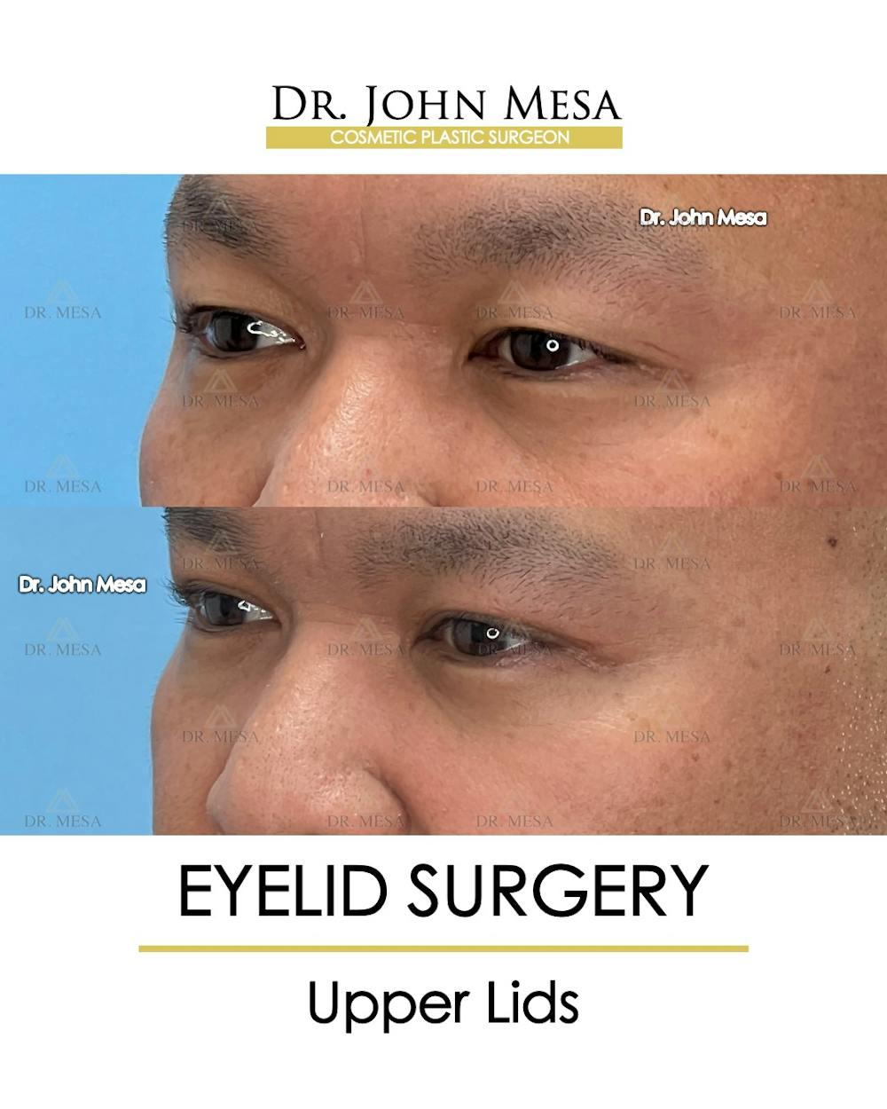 Eyelid Surgery Before & After Gallery - Patient 174902413 - Image 4