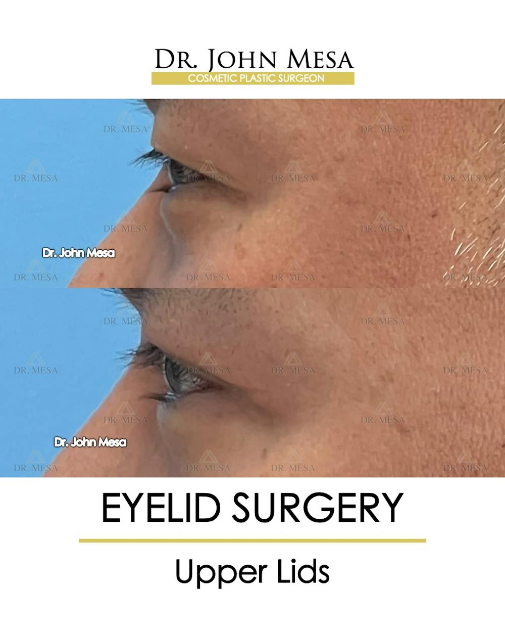 Eyelid Surgery Before & After Gallery - Patient 174902413 - Image 6