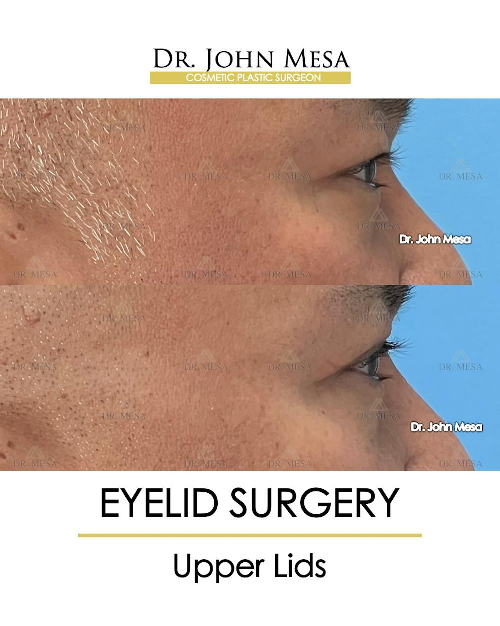 Eyelid Surgery Before & After Gallery - Patient 174902413 - Image 5