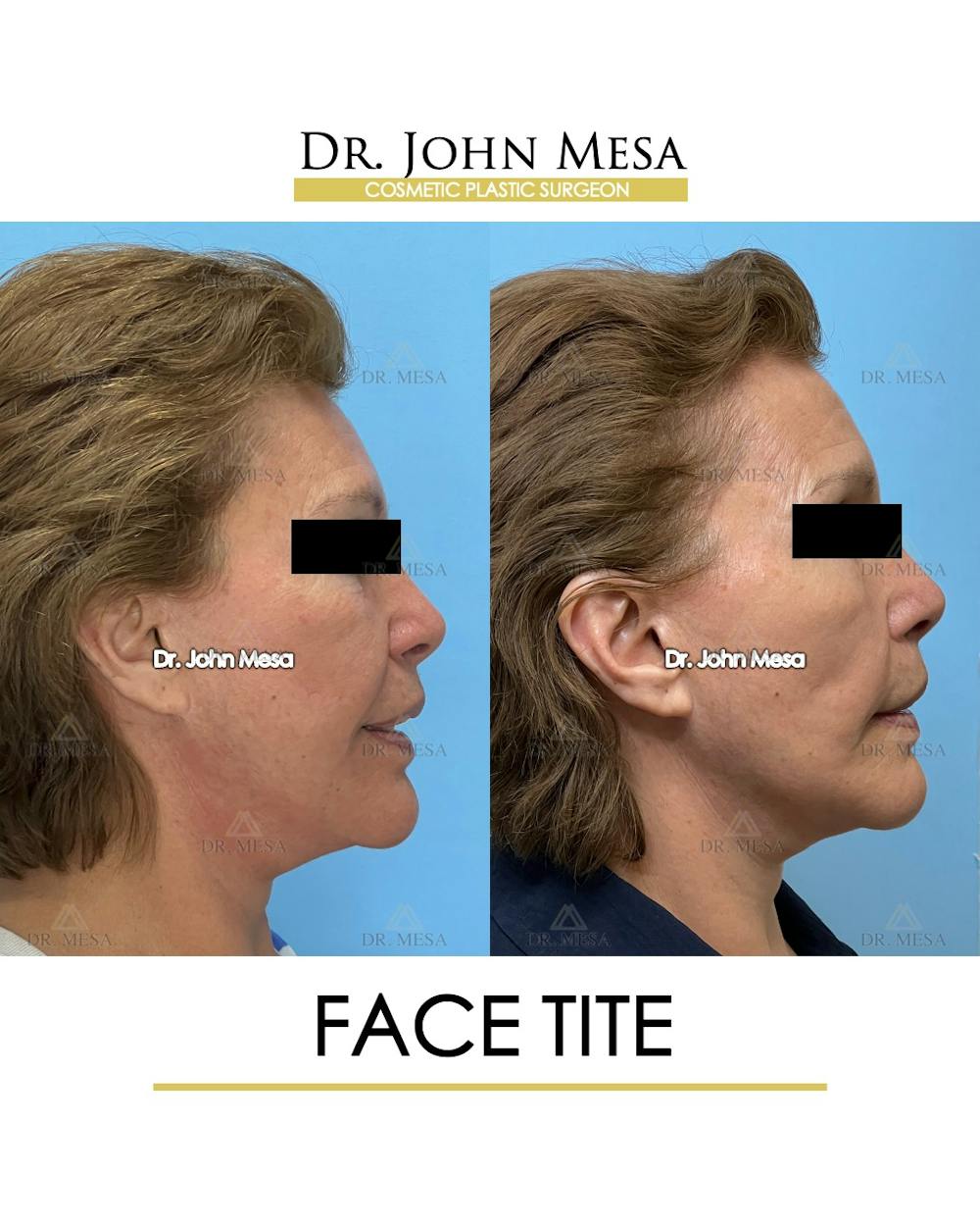 FaceTite Before & After Gallery - Patient 174902414 - Image 3