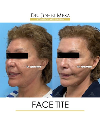 FaceTite Before & After Gallery - Patient 174902414 - Image 4