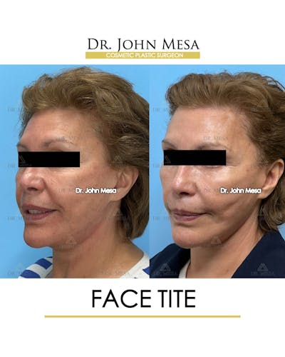 FaceTite Before & After Gallery - Patient 174902414 - Image 4