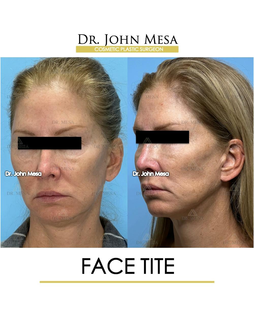 FaceTite Before & After Gallery - Patient 174902415 - Image 3