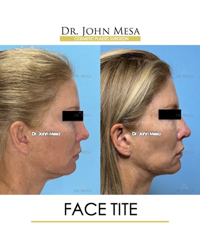 FaceTite Before & After Gallery - Patient 174902415 - Image 4