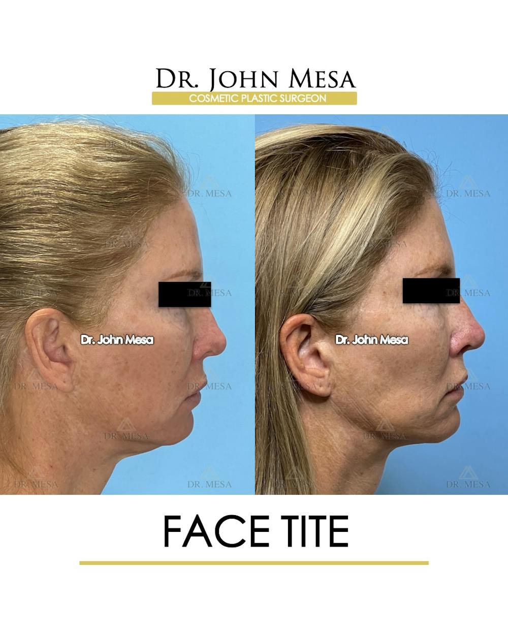 FaceTite Before & After Gallery - Patient 174902415 - Image 4
