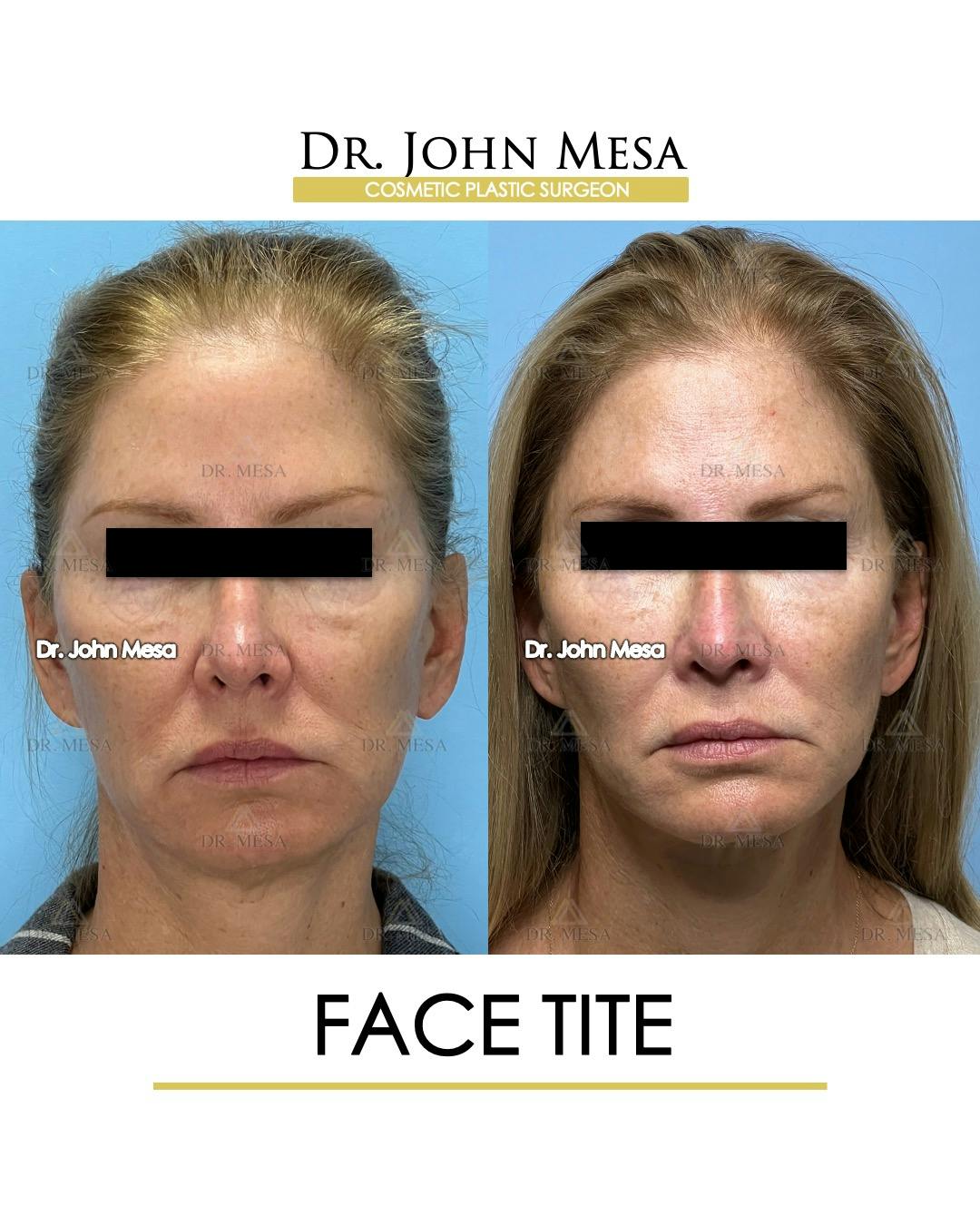 FaceTite Before & After Gallery - Patient 174902415 - Image 1