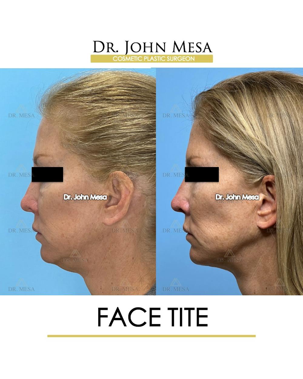 FaceTite Before & After Gallery - Patient 174902415 - Image 5