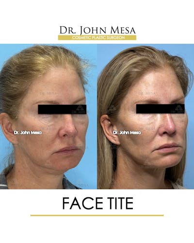 FaceTite Before & After Gallery - Patient 174902415 - Image 2