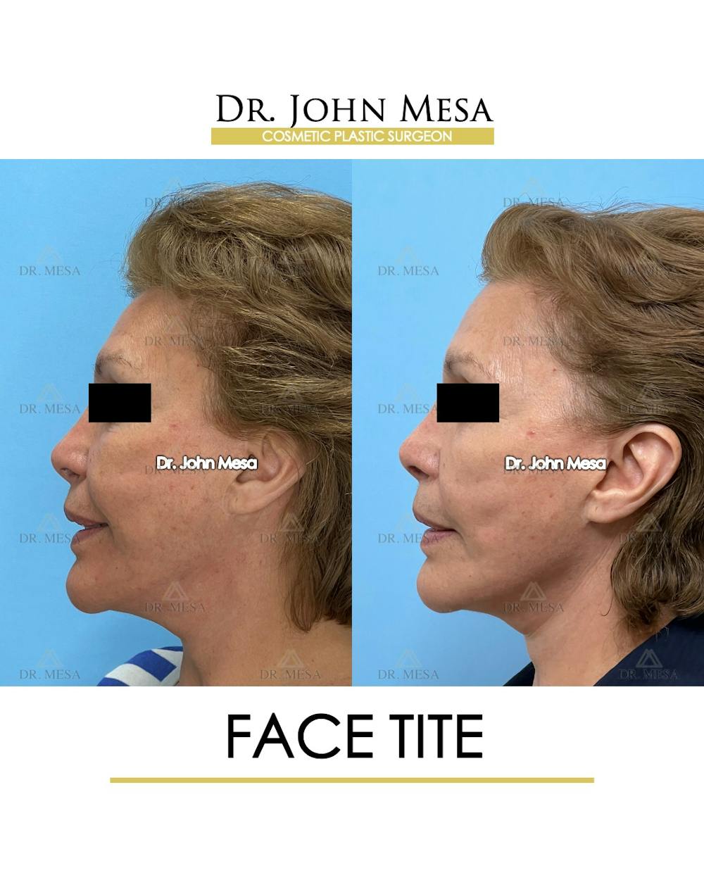FaceTite Before & After Gallery - Patient 174902414 - Image 5