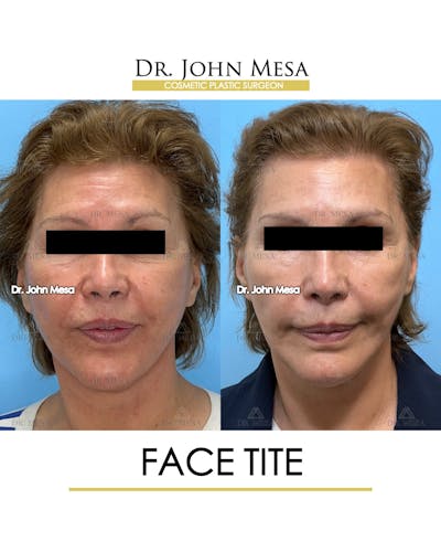 FaceTite Before & After Gallery - Patient 174902414 - Image 1