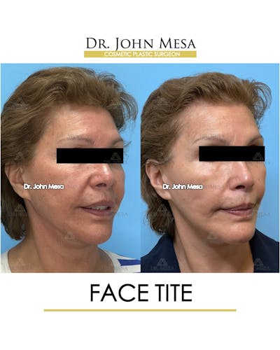FaceTite Before & After Gallery - Patient 174902414 - Image 2