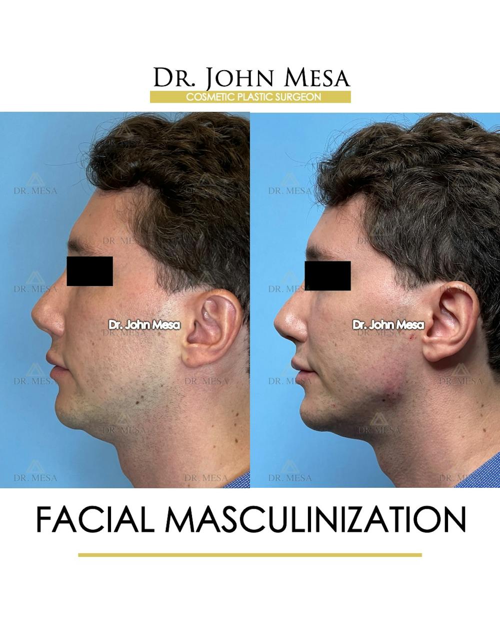Facial Masculinization Before & After Gallery - Patient 174902715 - Image 5