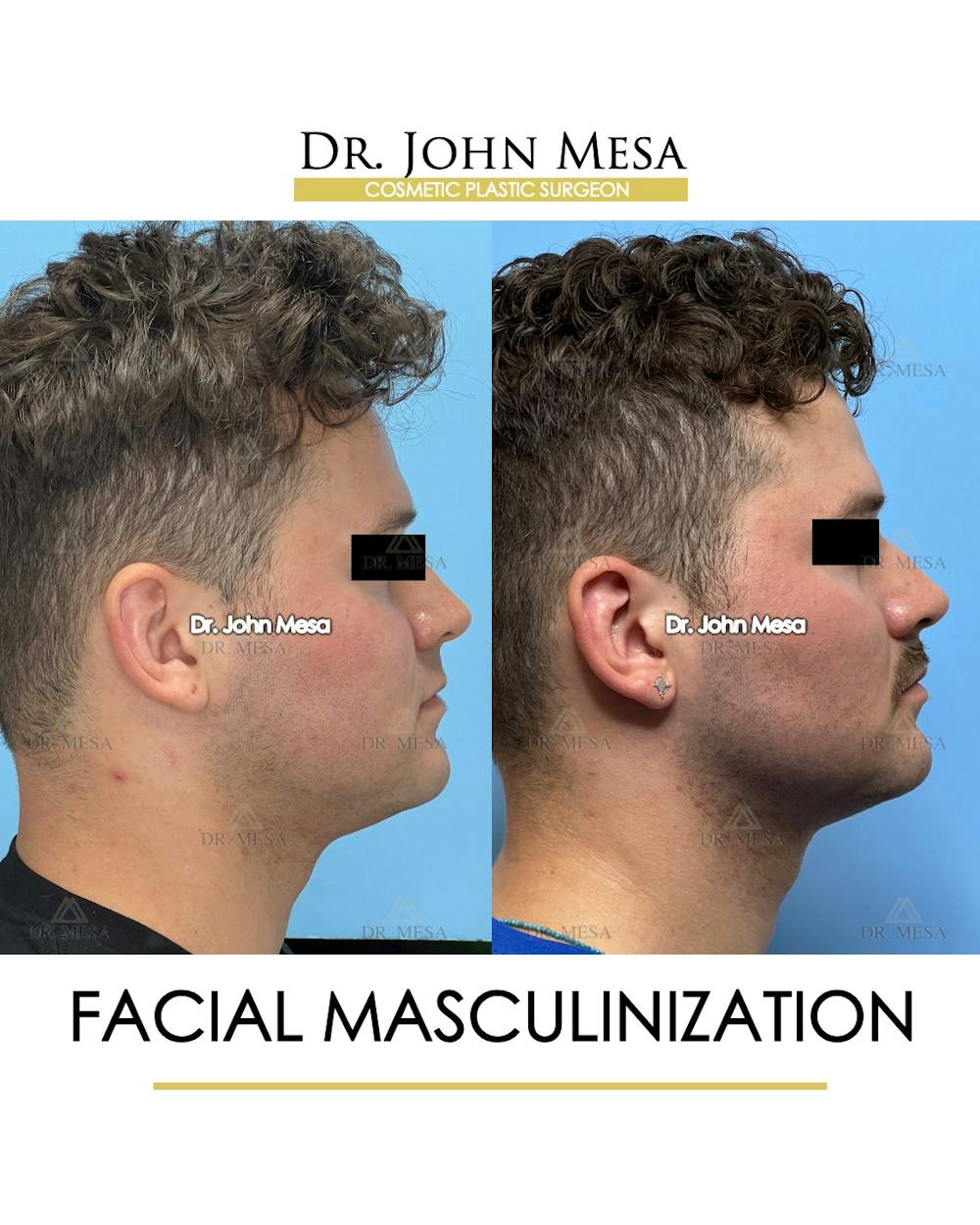 Facial Masculinization Before & After Gallery - Patient 174902462 - Image 3