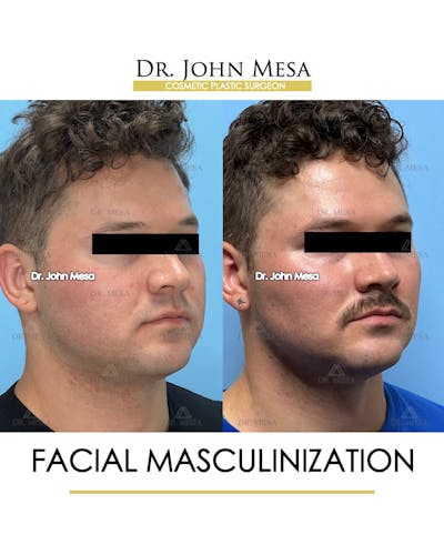 Facial Masculinization Before & After Gallery - Patient 174902462 - Image 2