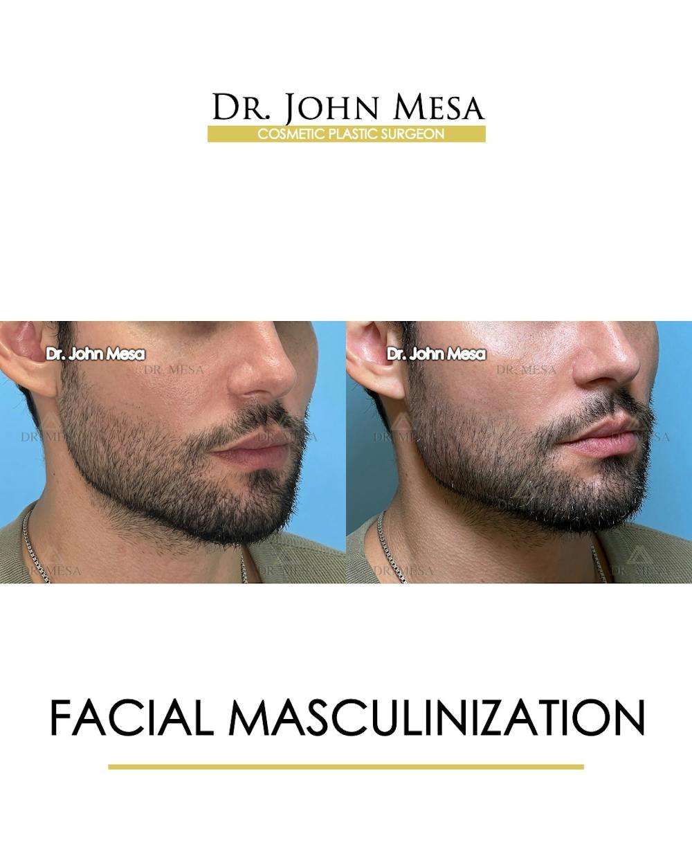 Facial Masculinization Before & After Gallery - Patient 174902535 - Image 2
