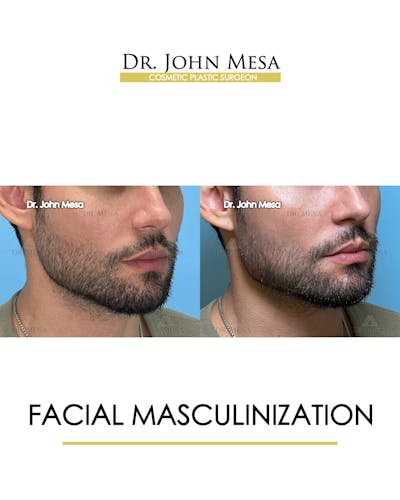 Facial Masculinization Before & After Gallery - Patient 174902535 - Image 2