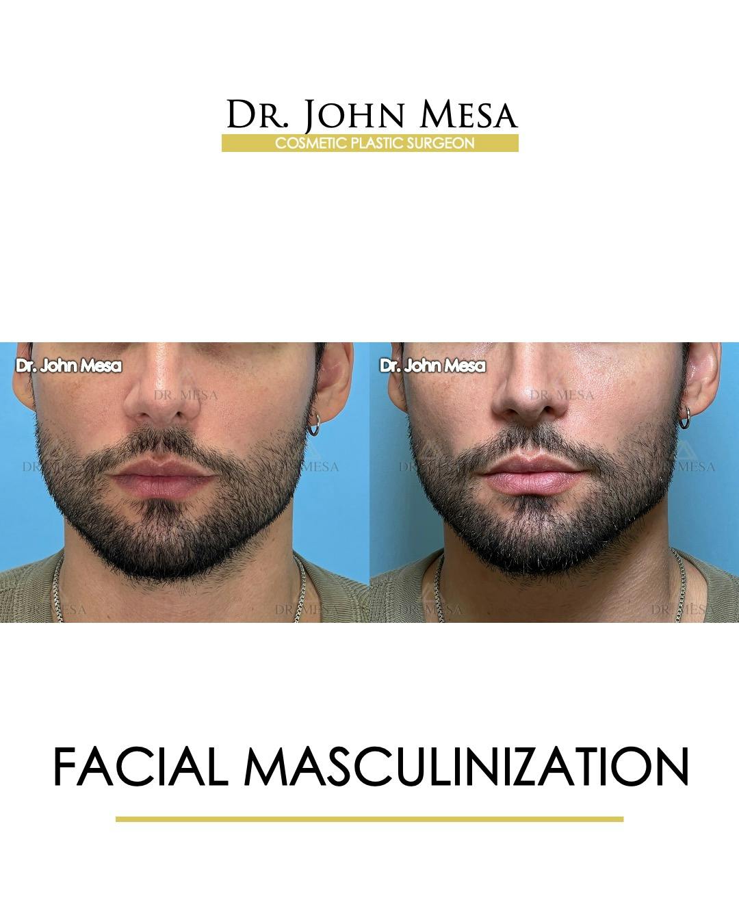 Facial Masculinization Before After Photos Dr Mesa Facial Masculinization Before After Photos Dr Mesa