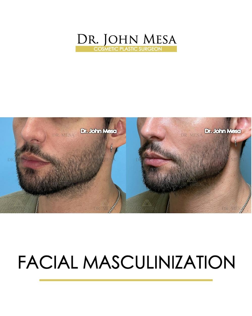 Facial Masculinization Before & After Gallery - Patient 174902535 - Image 5
