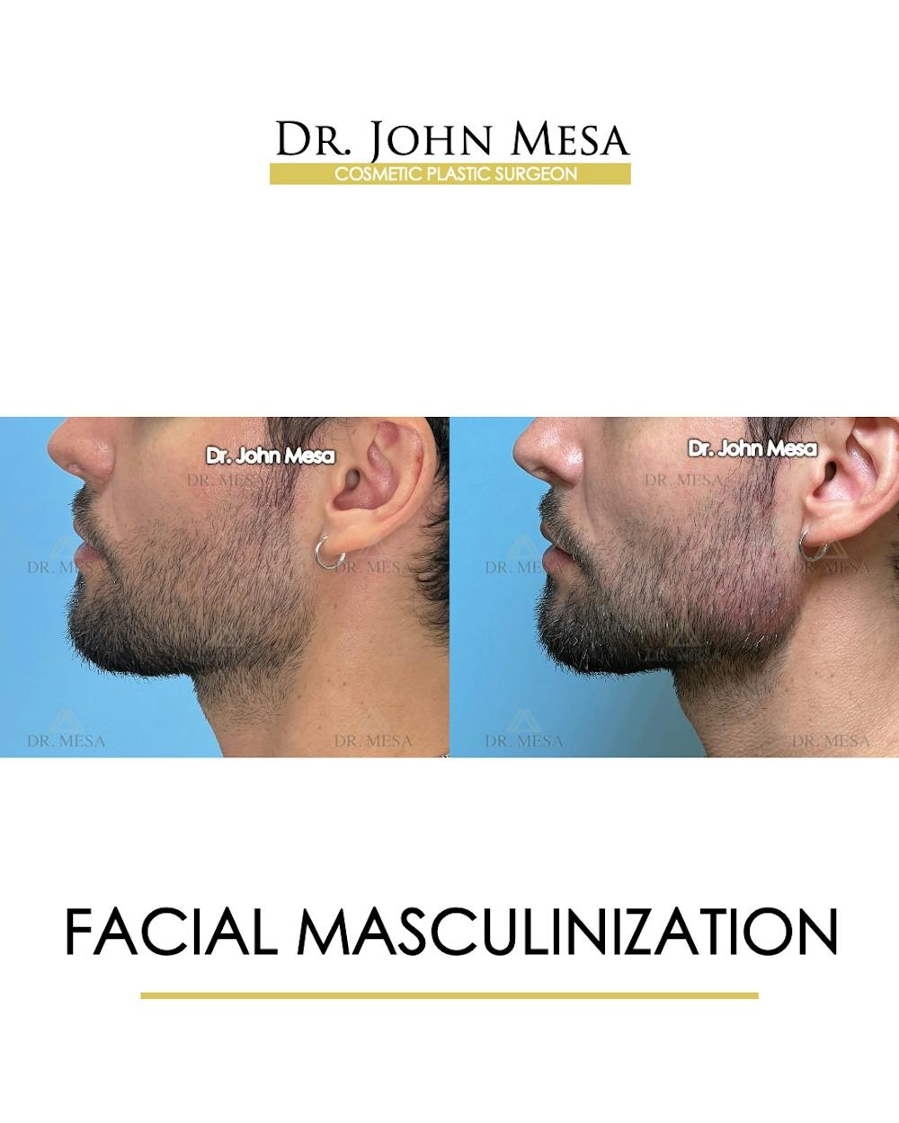 Facial Masculinization Before & After Gallery - Patient 174902535 - Image 4