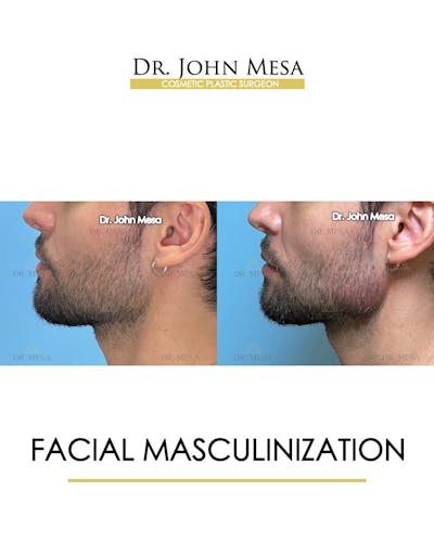 Facial Masculinization Before & After Gallery - Patient 174902535 - Image 4