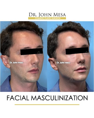 Facial Masculinization Before & After Gallery - Patient 174902715 - Image 2