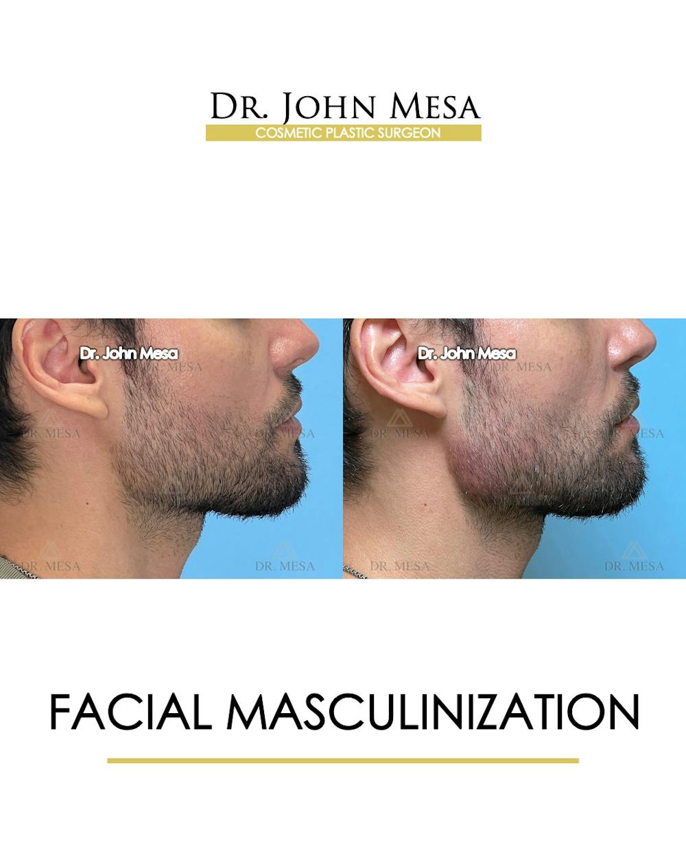 Facial Masculinization Before & After Gallery - Patient 174902535 - Image 3