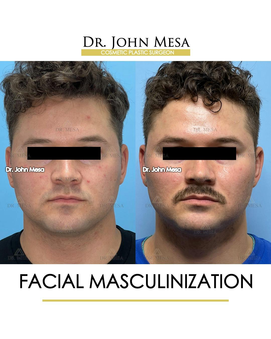 Facial Masculinization Before & After Gallery - Patient 174902462 - Image 1