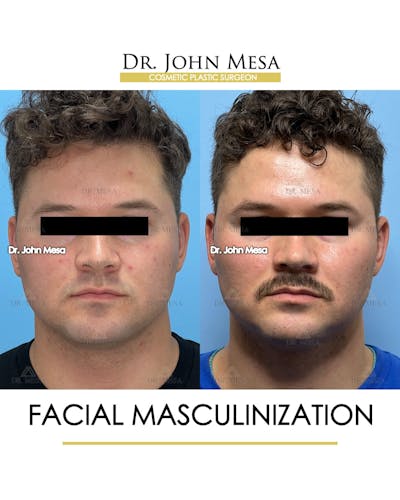 Facial Masculinization Before & After Gallery - Patient 174902462 - Image 1