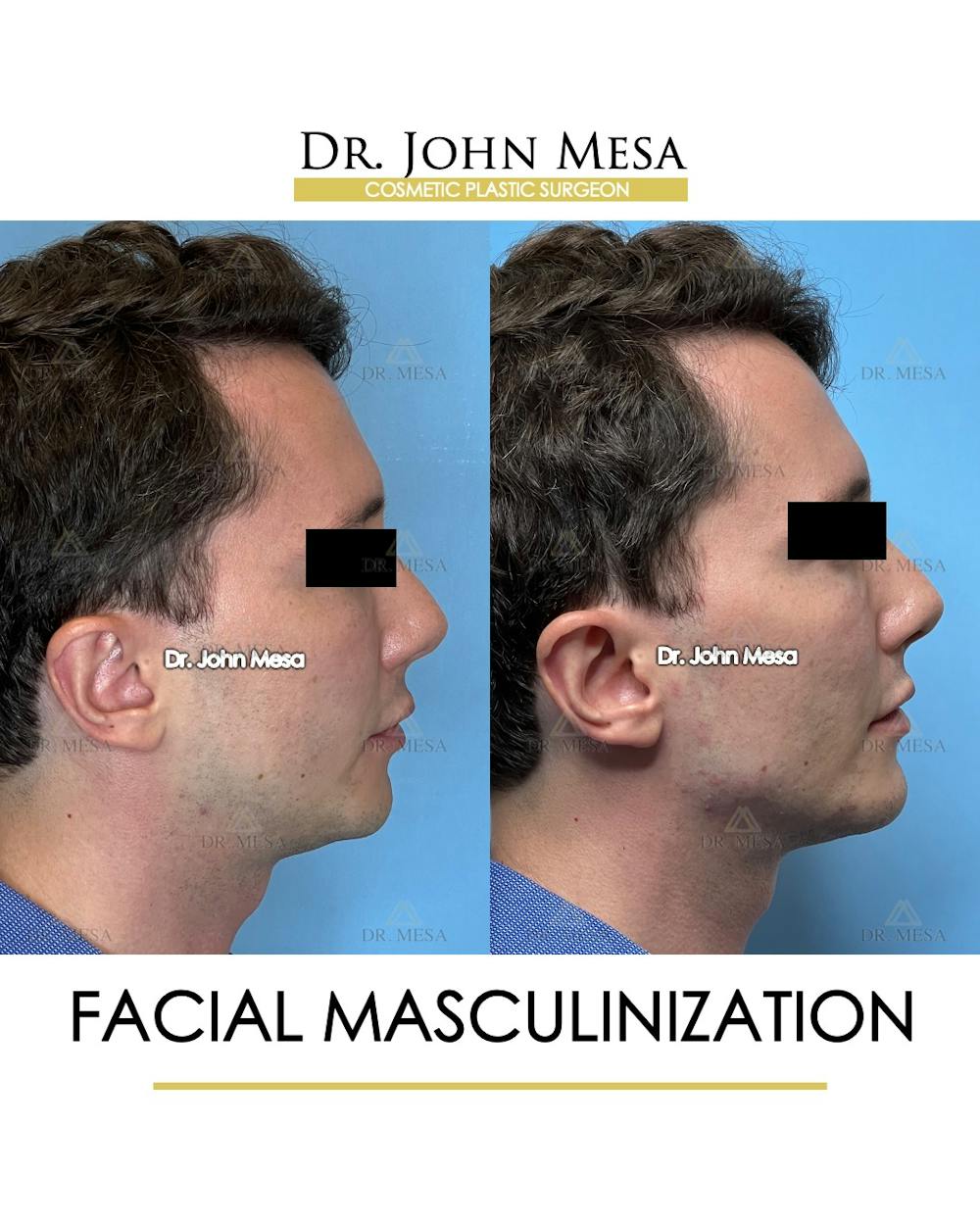 Facial Masculinization Before & After Gallery - Patient 174902715 - Image 3