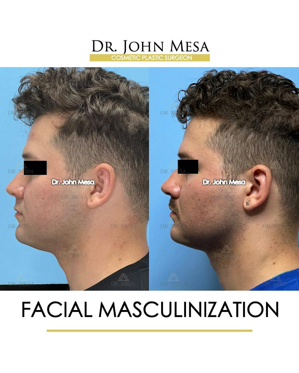 Facial Masculinization Before & After Gallery - Patient 174902462 - Image 5