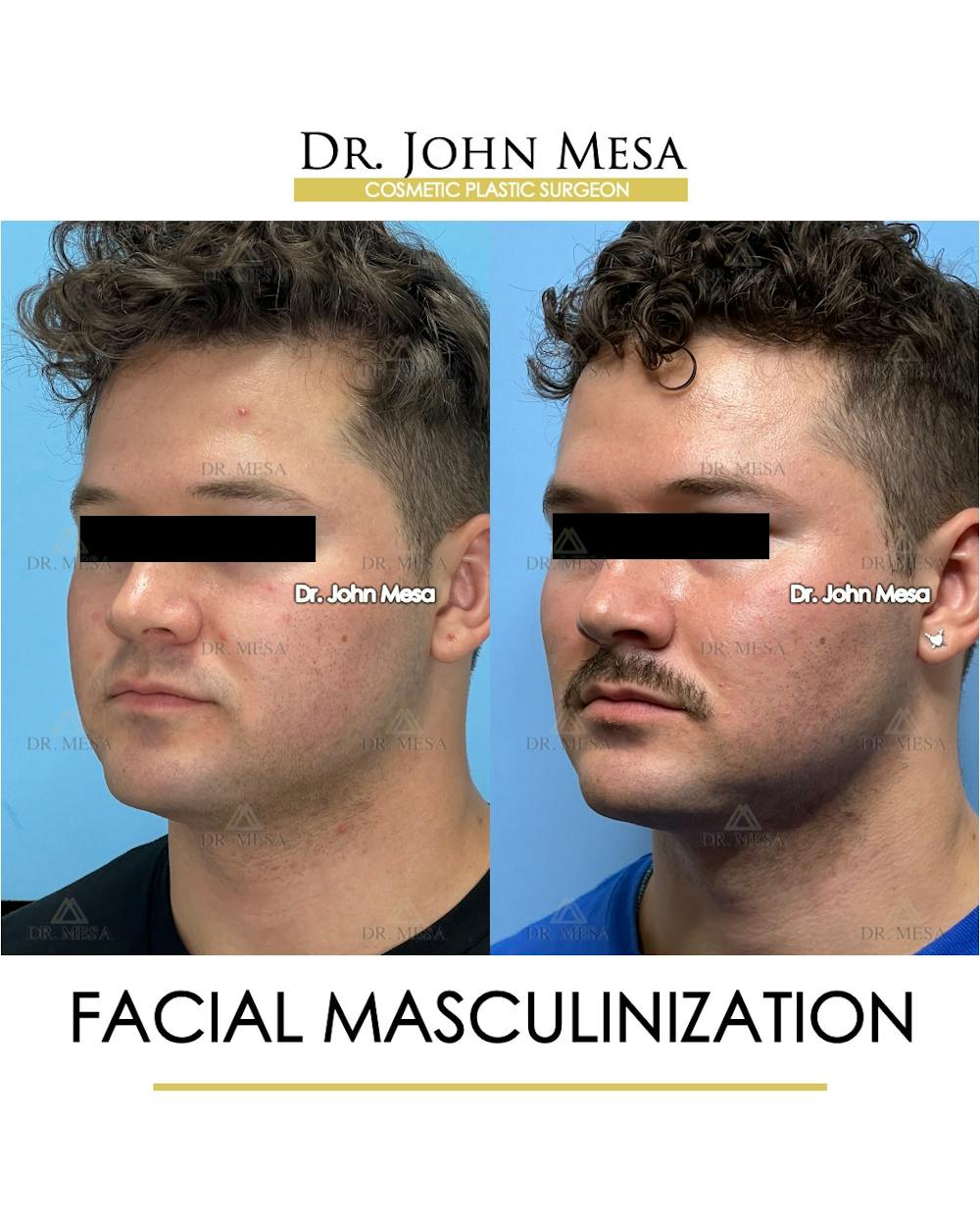Facial Masculinization Before & After Gallery - Patient 174902462 - Image 4