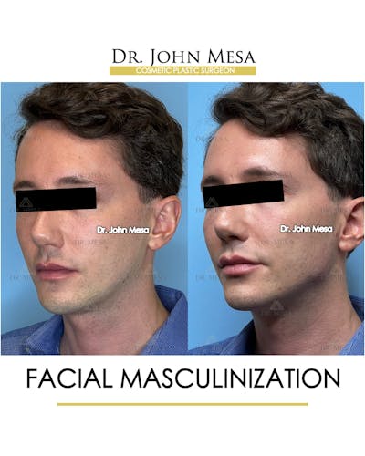 Facial Masculinization Before & After Gallery - Patient 174902715 - Image 4