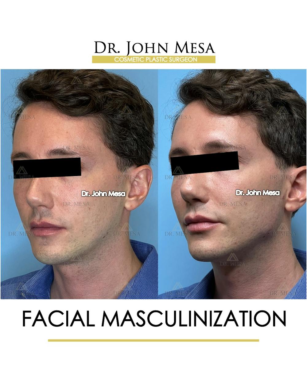 Facial Masculinization Before & After Gallery - Patient 174902715 - Image 4