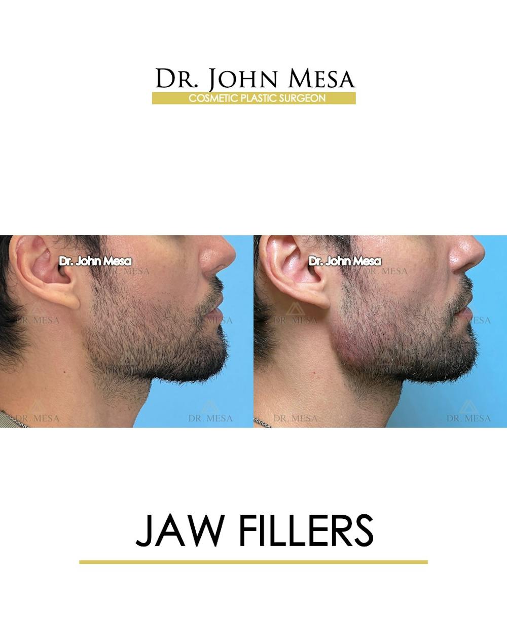 Jaw Filler Before & After Gallery - Patient 174911845 - Image 3