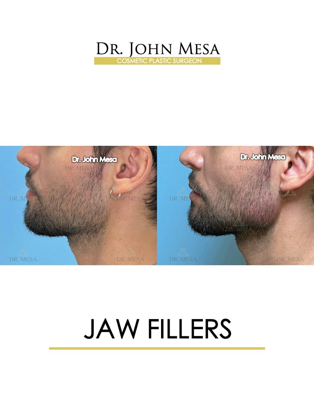 Jaw Filler Before & After Gallery - Patient 174911845 - Image 5