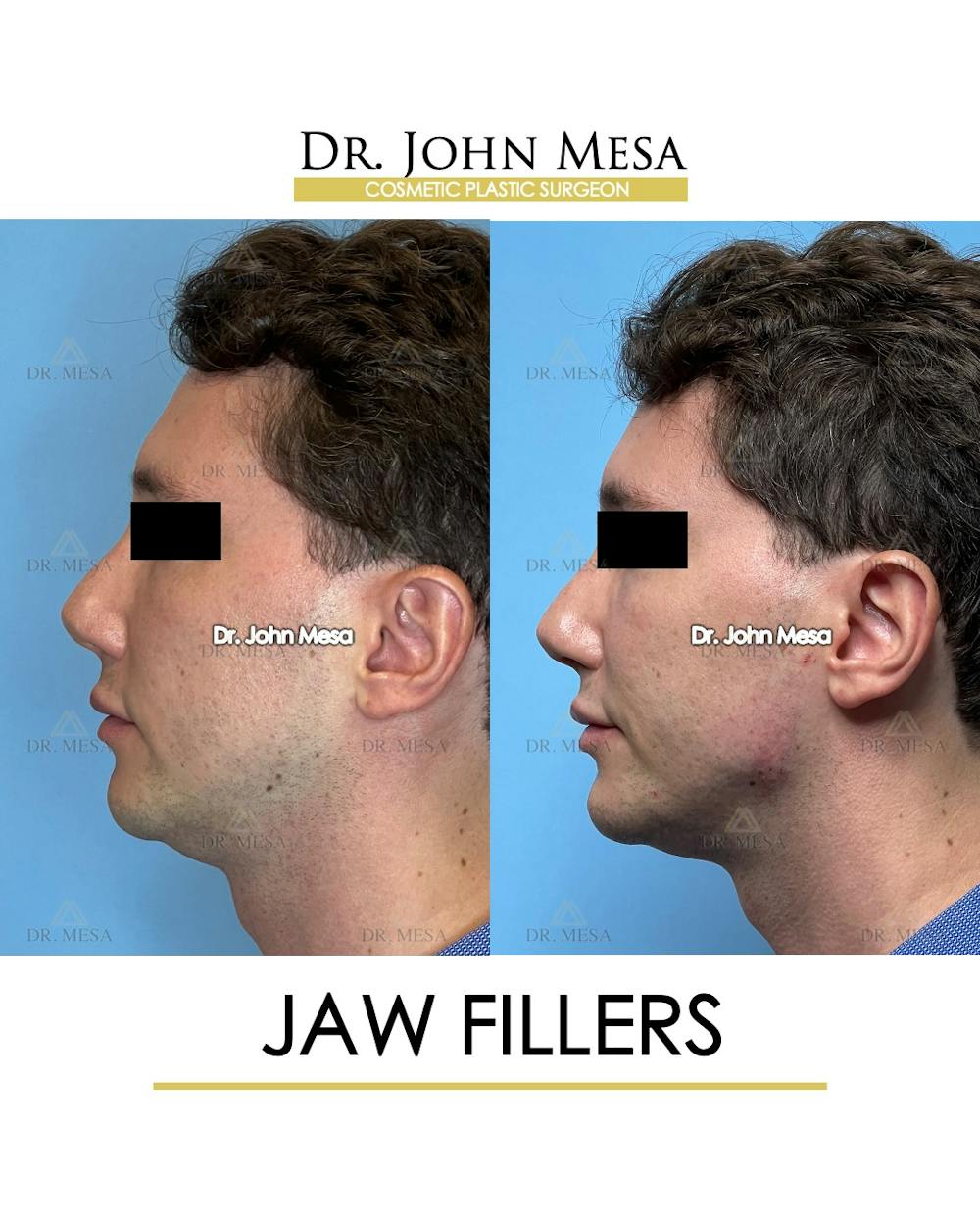Jaw Filler Before & After Gallery - Patient 174911792 - Image 5