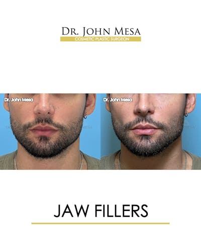 Jaw Filler Before & After Gallery - Patient 174911845 - Image 1