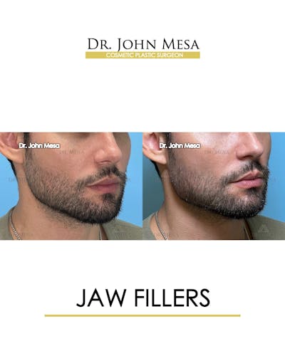 Jaw Filler Before & After Gallery - Patient 174911845 - Image 2