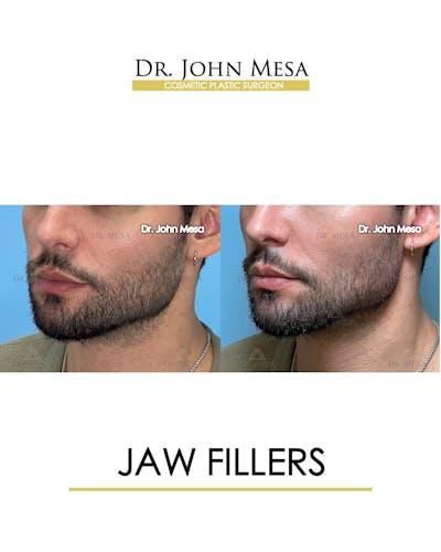 Jaw Filler Before & After Gallery - Patient 174911845 - Image 4