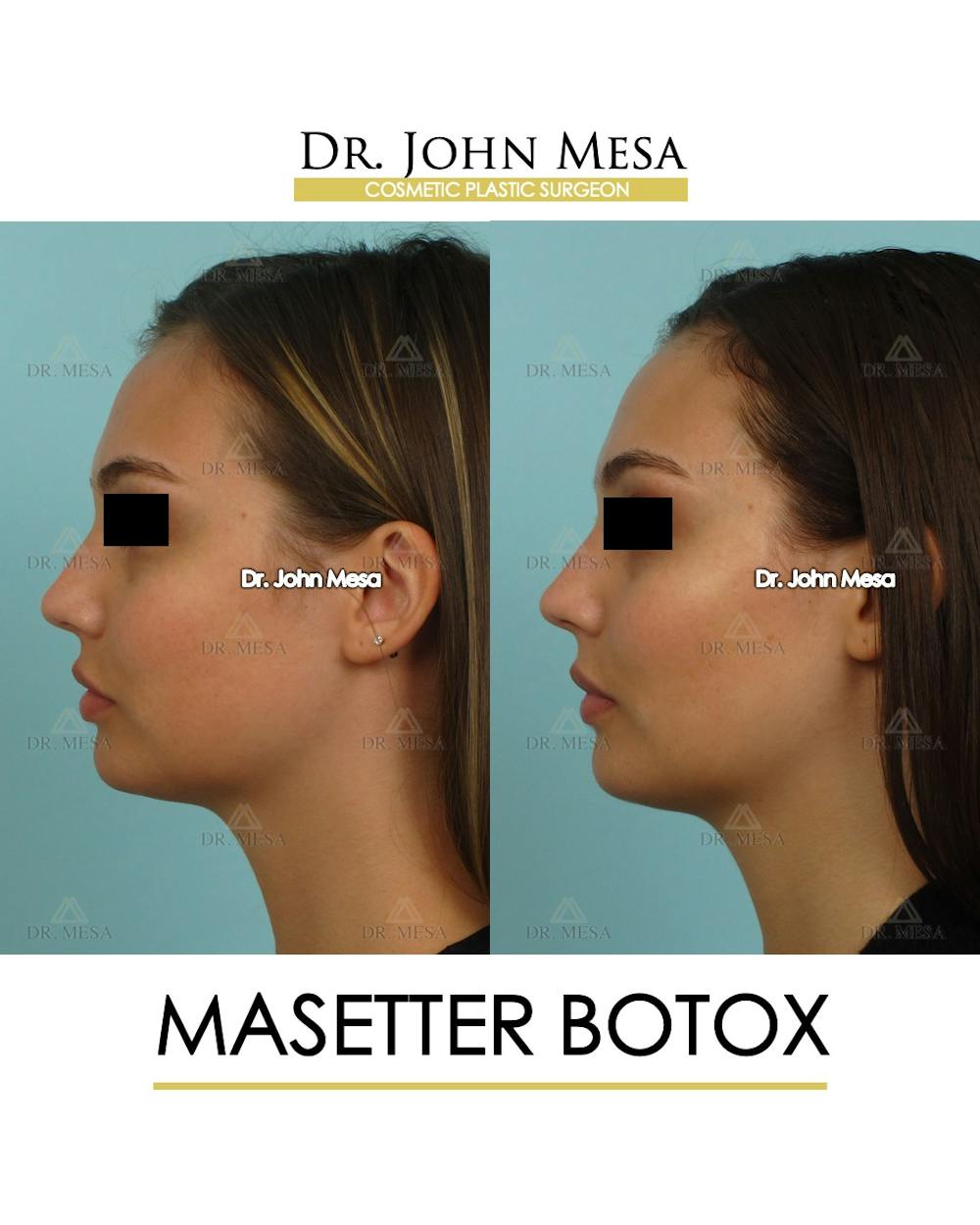 Botox Before & After Gallery - Patient 174911876 - Image 5