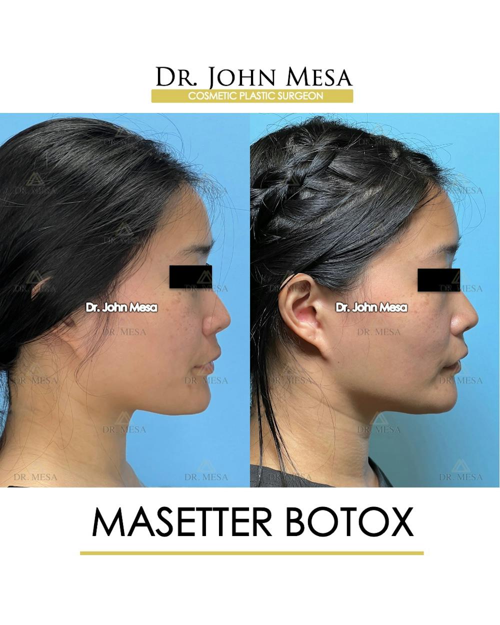 Botox Before & After Gallery - Patient 174966890 - Image 3