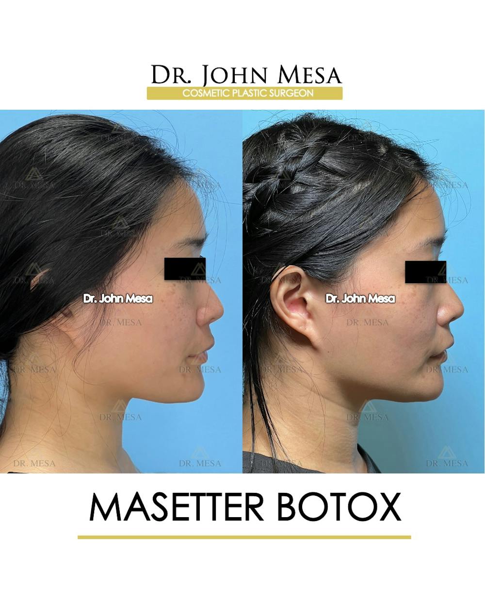 BOTOX Before & After Gallery - Patient 174966890 - Image 3