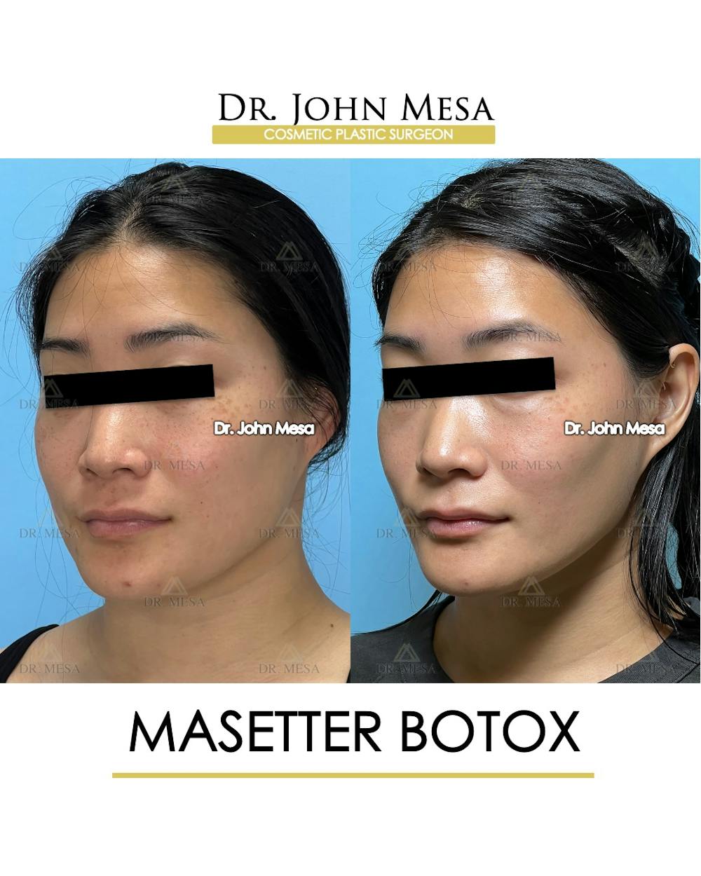 Botox Before & After Gallery - Patient 174966890 - Image 4