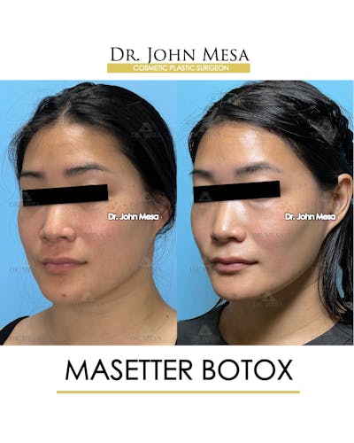 Botox Before & After Gallery - Patient 174966890 - Image 4