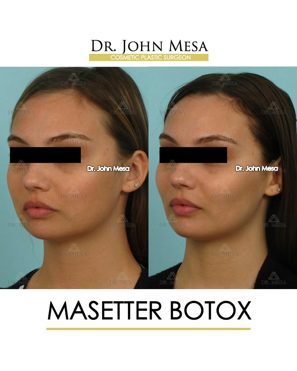Botox Before & After Gallery - Patient 174911876 - Image 4