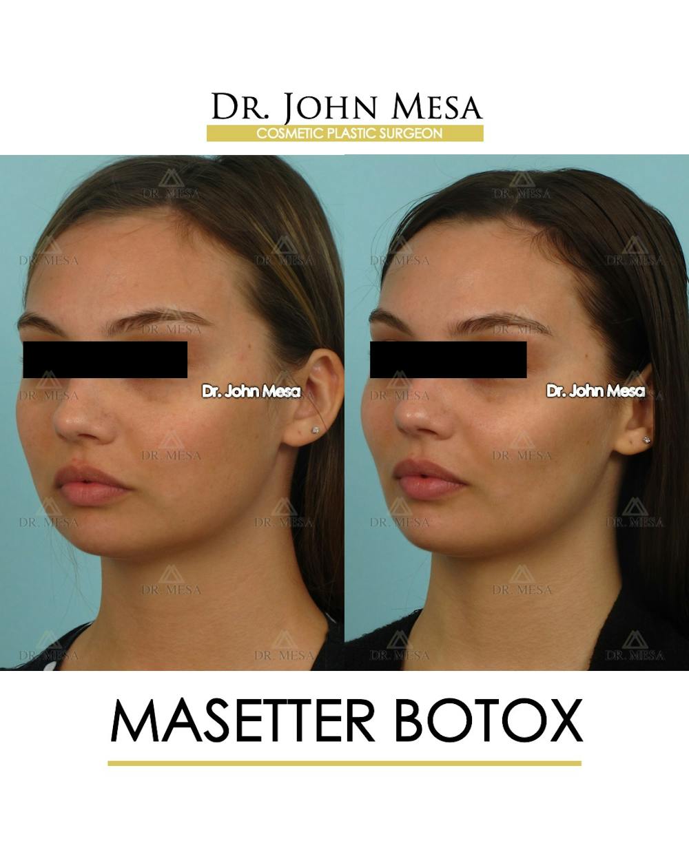 BOTOX Before & After Gallery - Patient 174911876 - Image 4