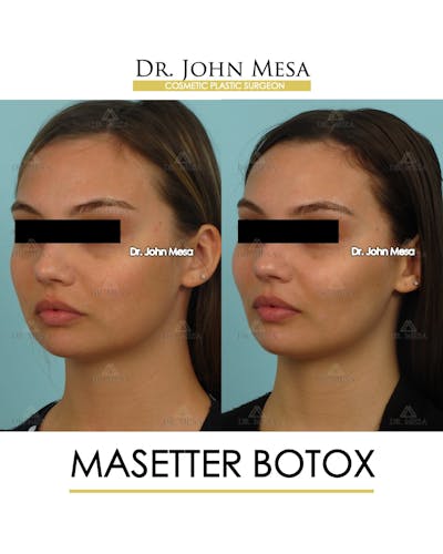 Botox Before & After Gallery - Patient 174911876 - Image 4