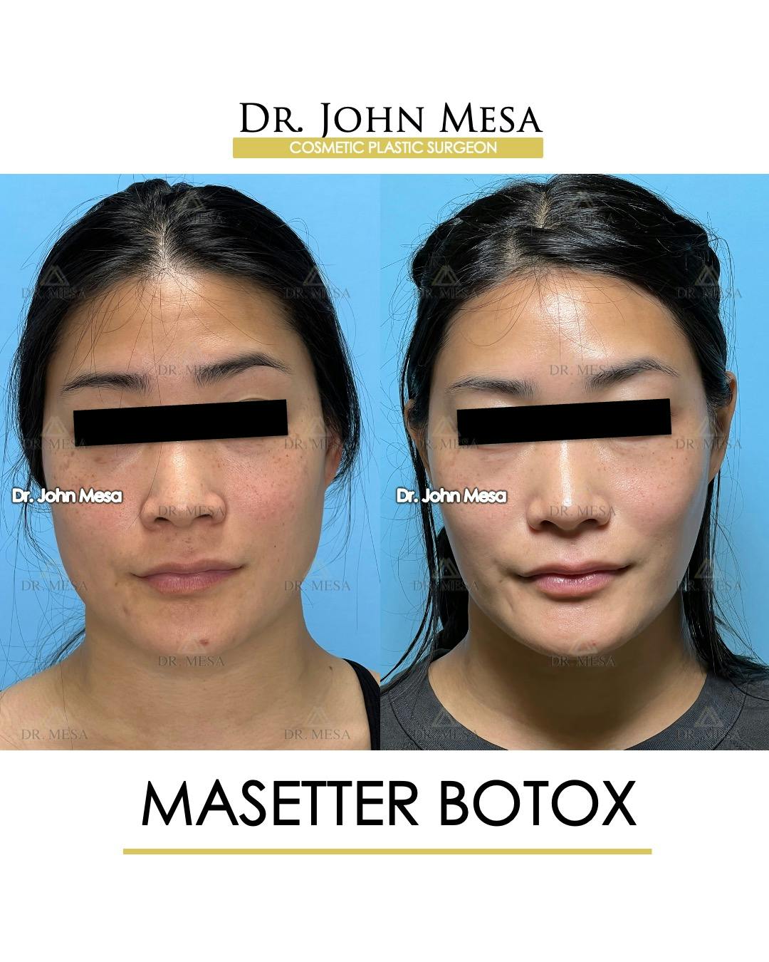 BOTOX Before & After Gallery - Patient 174966890 - Image 1