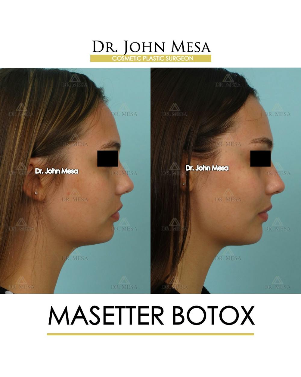 BOTOX Before & After Gallery - Patient 174911876 - Image 3